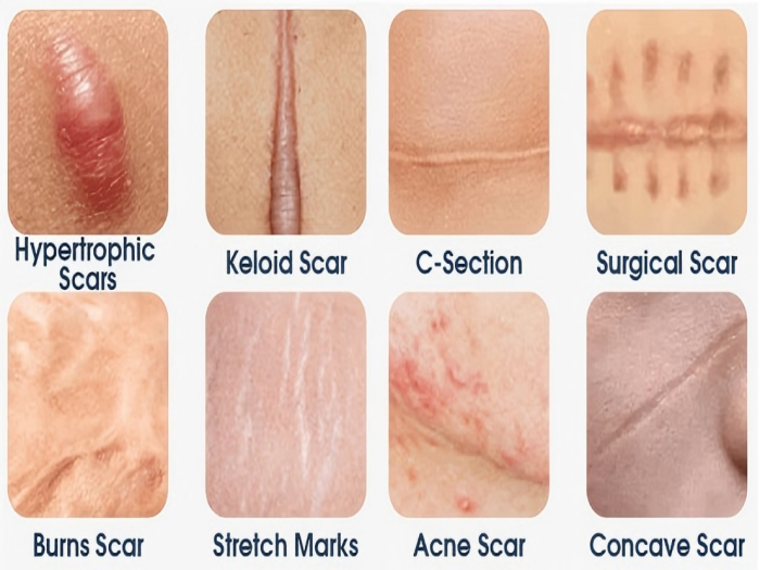 DOES RED LIGHT DO FOR SCARS